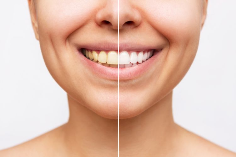 Devastar Anillo duro Joseph Banks Limpieza dental: ¿Por qué debes hacerla? | Reyes de Navarra