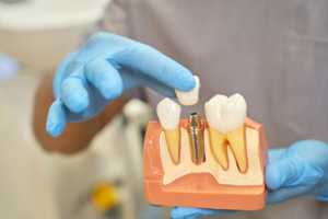 implante dental 