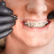 ortodoncia dental brackets