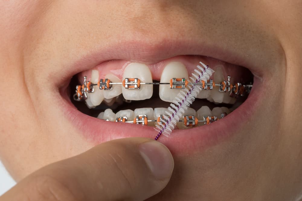 Es normal tener mal aliento por los aparatos dentales?