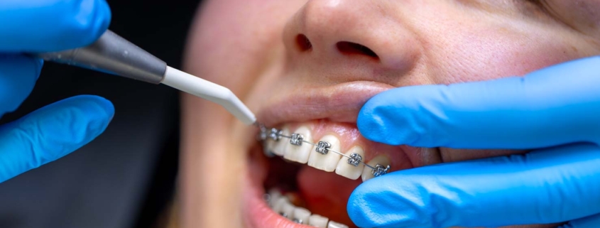 Dentista colocando ortodoncia a una paciente